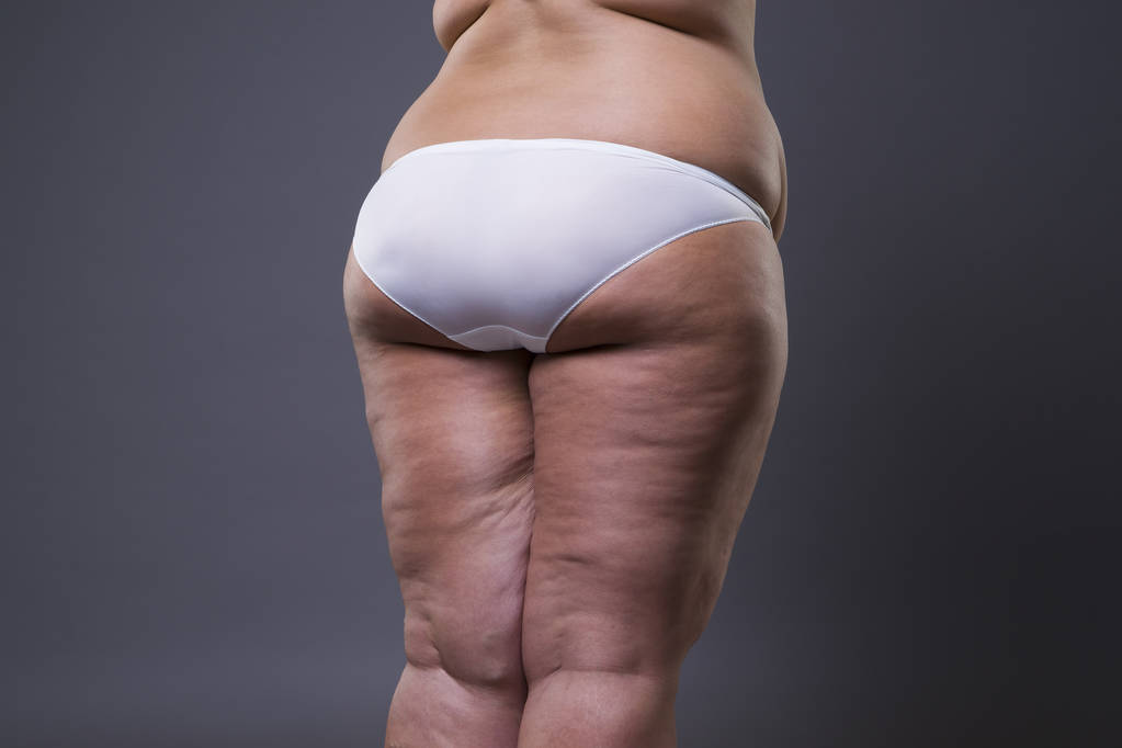 Ylipainoinen nainen rasvaa jalat ja pakarat, lihavuus naisen kehon
 - Valokuva, kuva