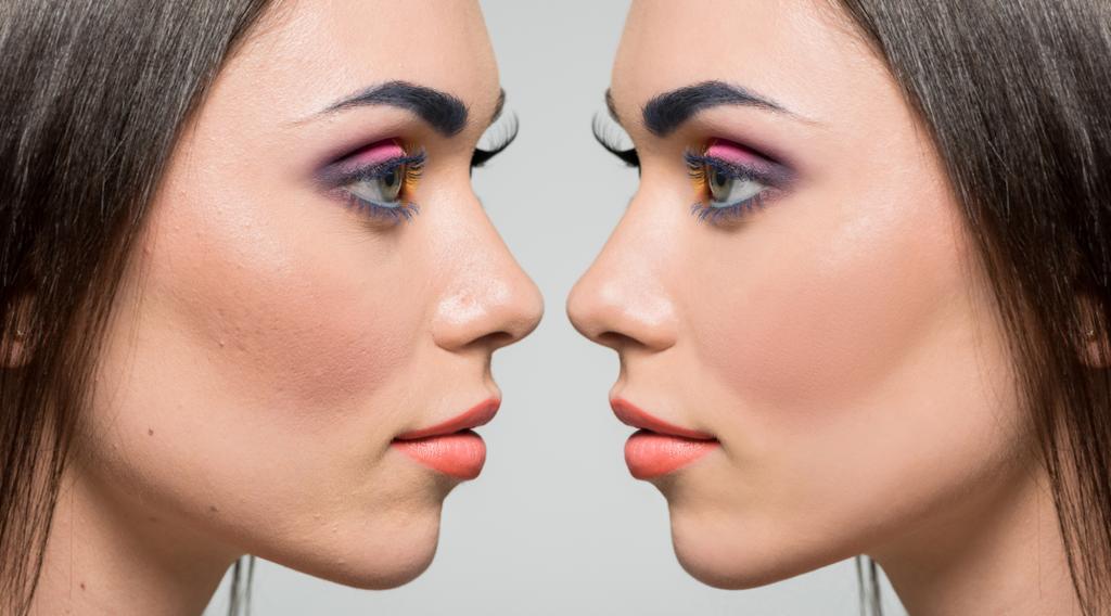 Naisen kasvot ennen ja jälkeen korjauksen
 - Valokuva, kuva