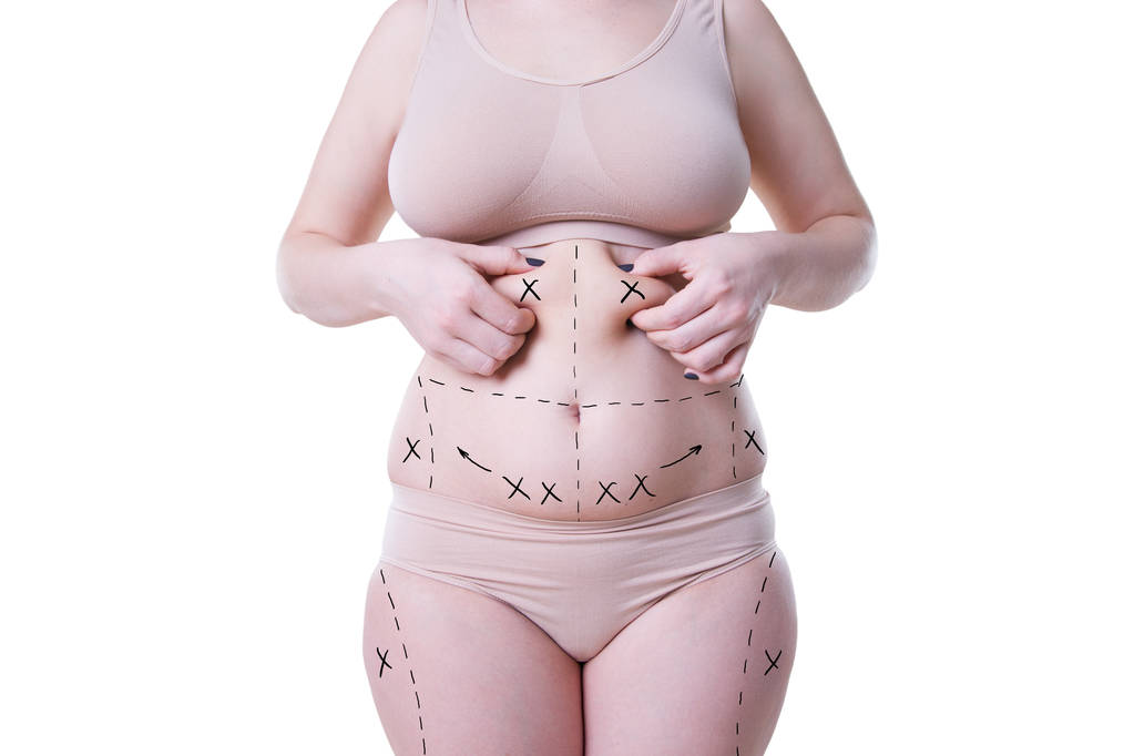 Липосакция, удаление жира и целлюлита, избыточный вес женского тела с покрашенными линиями и стрелами
 - Фото, изображение