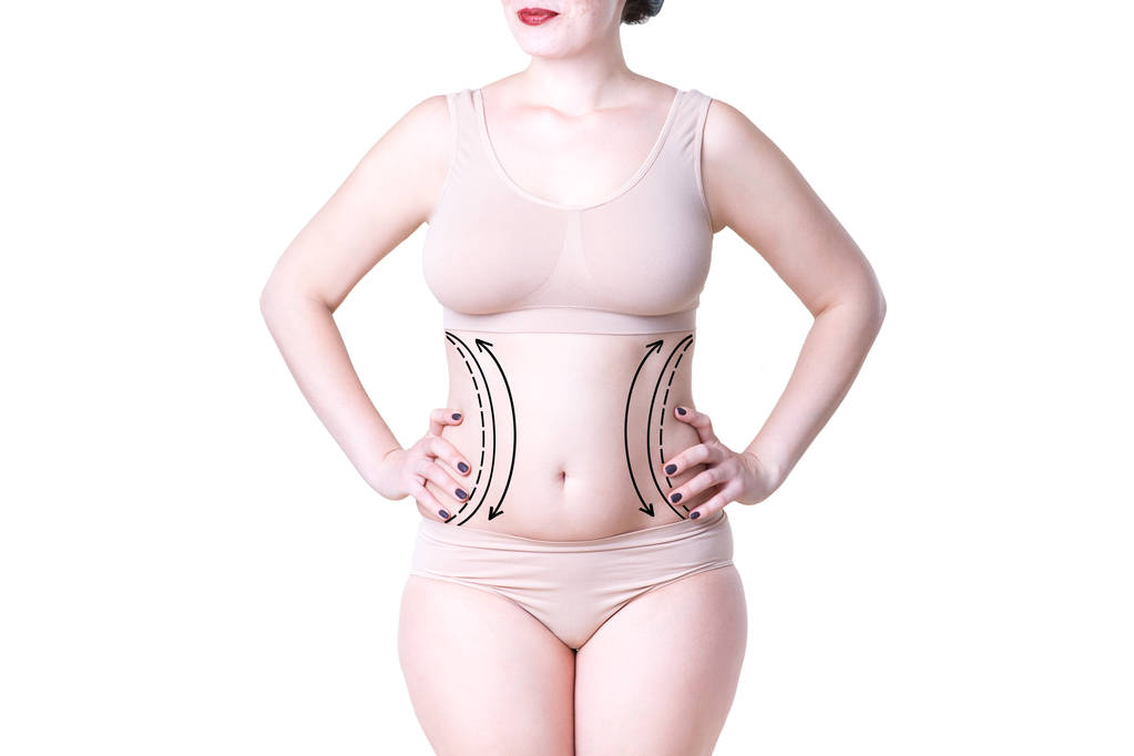 Liposucción, concepto de eliminación de grasa y celulitis, cuerpo femenino con sobrepeso con líneas y flechas pintadas
 - Foto, imagen