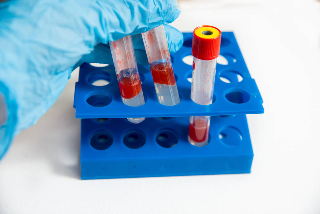 El médico o asistente de laboratorio toma tubos de ensayo médicos de vidrio, en un guante azul, un trípode azul en el fondo. sobre un fondo blanco
 - Foto, imagen
