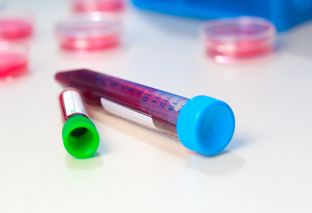 Blood In tube per analisi di laboratorio
 - Foto, immagini