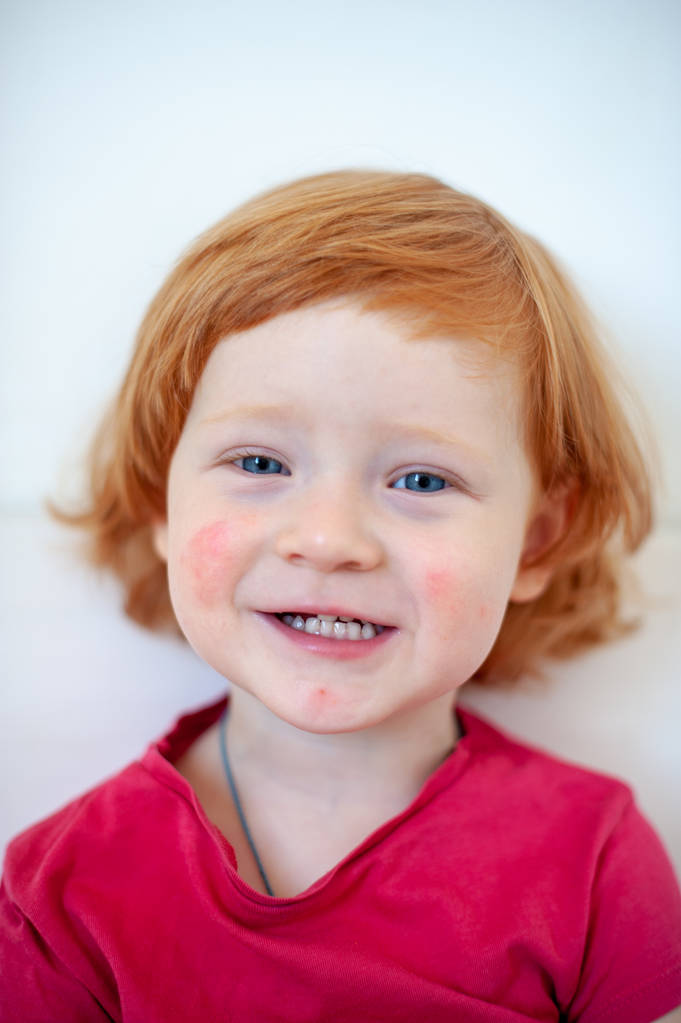 A gyermek jeleit az arcon allergia - Fotó, kép