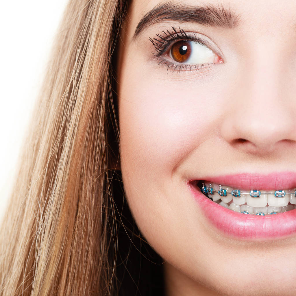 Dentysta i ortodonta. Kobieta uśmiech pokazując swoje białe zęby z niebieskimi aparatami na zęby - Zdjęcie, obraz