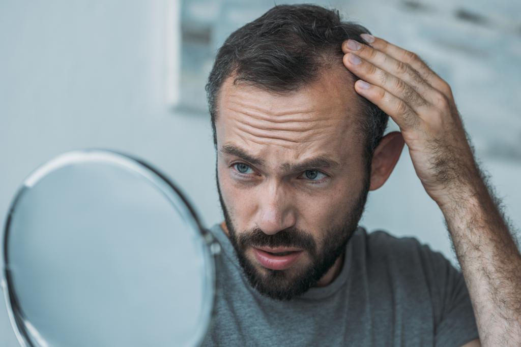 Расстроенный мужчина средних лет с алопецией, смотрящий на зеркало, концепция выпадения волос  - Фото, изображение