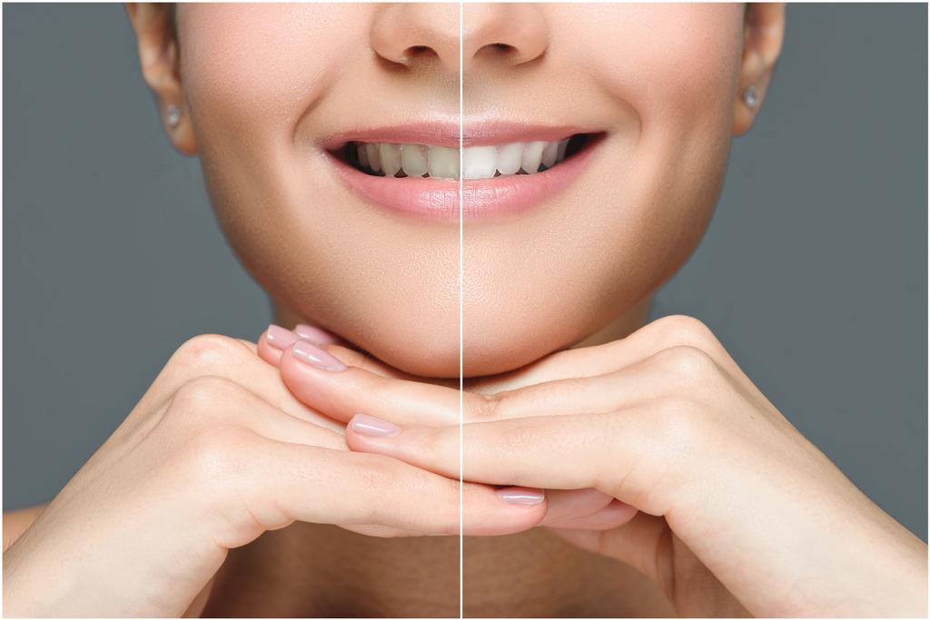 visión parcial de la mujer sonriente antes y después del blanqueamiento dental aislado en gris
 - Foto, Imagen