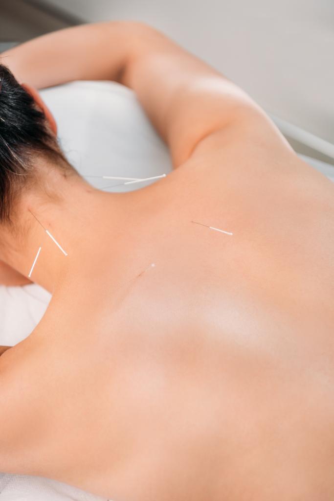 Teilansicht einer Frau mit Nadeln am Körper bei einer Akupunkturtherapie im Kursalon - Foto, Bild