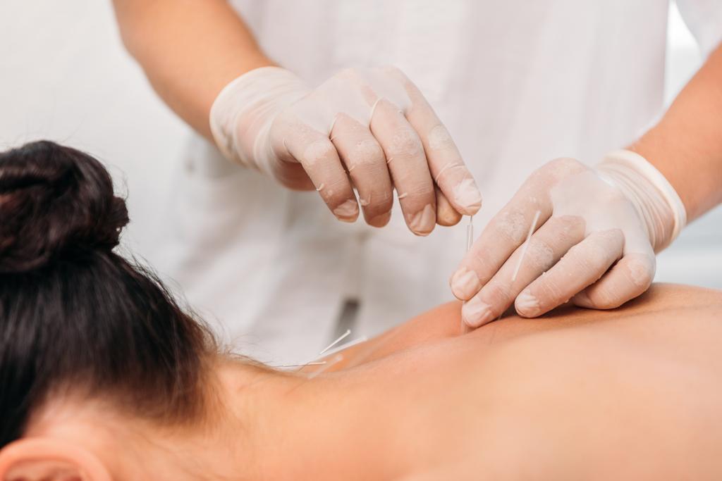 tiro cortado de cosmetologist colocando agulhas em mulheres de volta durante a terapia de acupuntura no salão de spa
 - Foto, Imagem