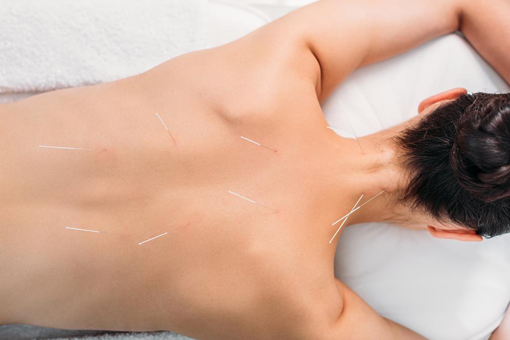 overhead view of woman with needles on body having acupuncture therapy in spa salon - Photo, Image