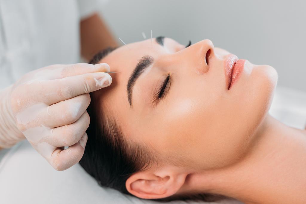 vue partielle du cosmétologue mettant des aiguilles sur le front des femmes pendant le traitement d'acupuncture dans le salon de spa
 - Photo, image