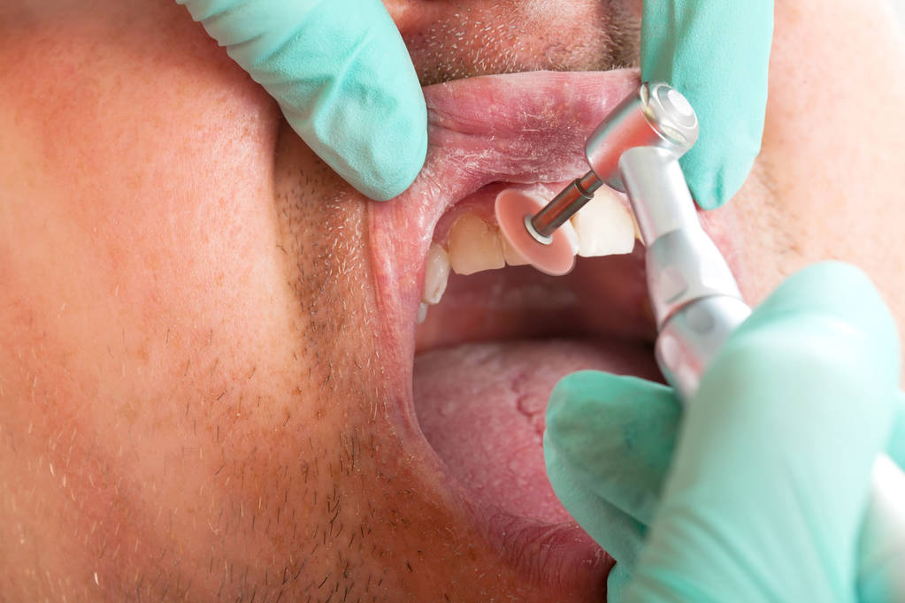 lähikuva hammaslääkäri käyttää poraa hammashoidon - miespotilaan suuontelon
 - Valokuva, kuva