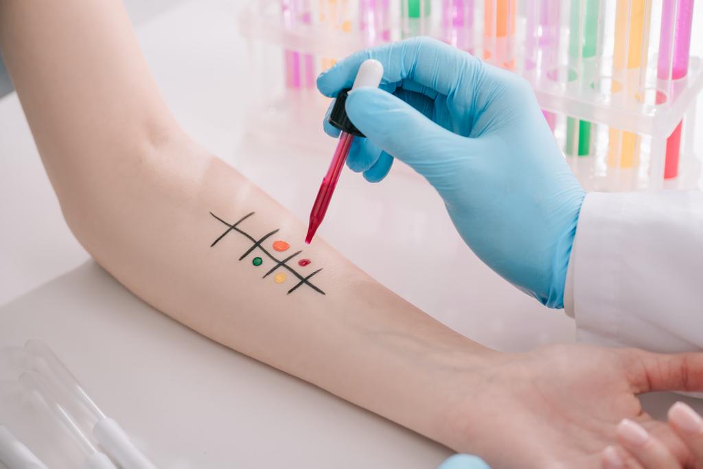 Ausgeschnittene Ansicht des Arztes in Latex-Handschuh, der Pipette mit Flüssigkeit hält, während er Allergietest macht - Foto, Bild