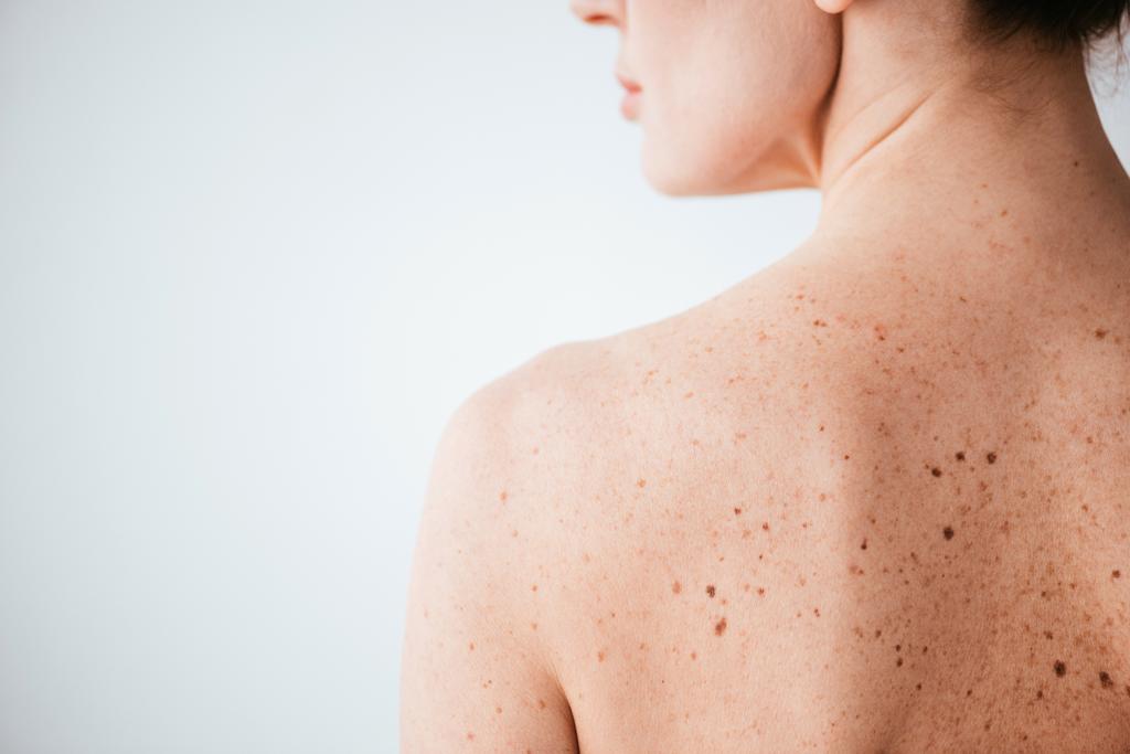 oříznutý pohled na nahou ženu s kožní nemocí na bílém  - Fotografie, Obrázek