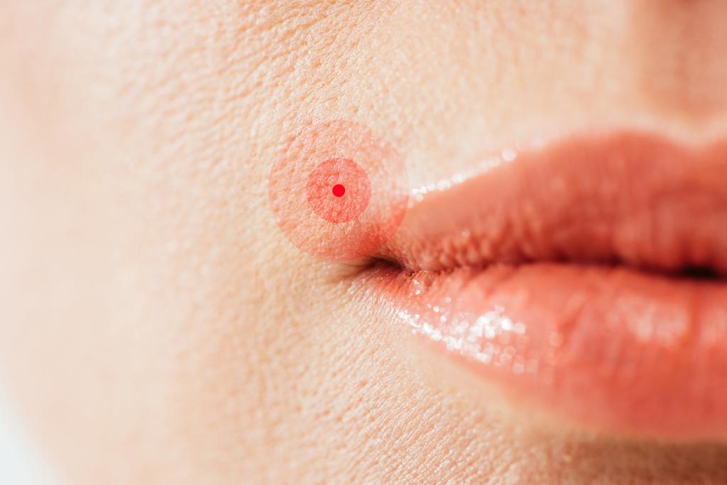 vista recortada de herpes en labios de mujer enferma
  - Foto, imagen