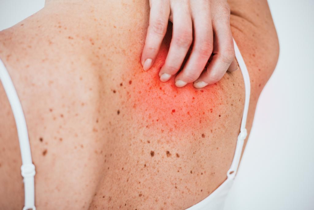 白で隔離された赤い皮膚を引っ掻くアレルギーの女性のトリミングされたビュー  - 写真・画像