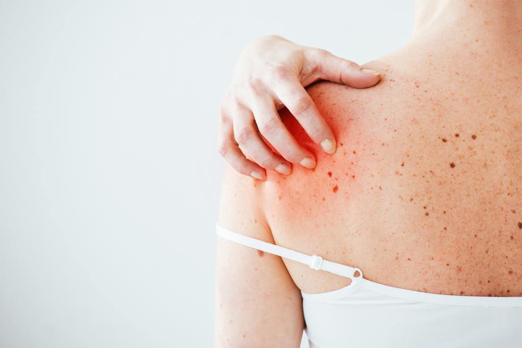 обрізаний вид хворої жінки з алергією подряпає червону шкіру на руці ізольовано на білому
  - Фото, зображення