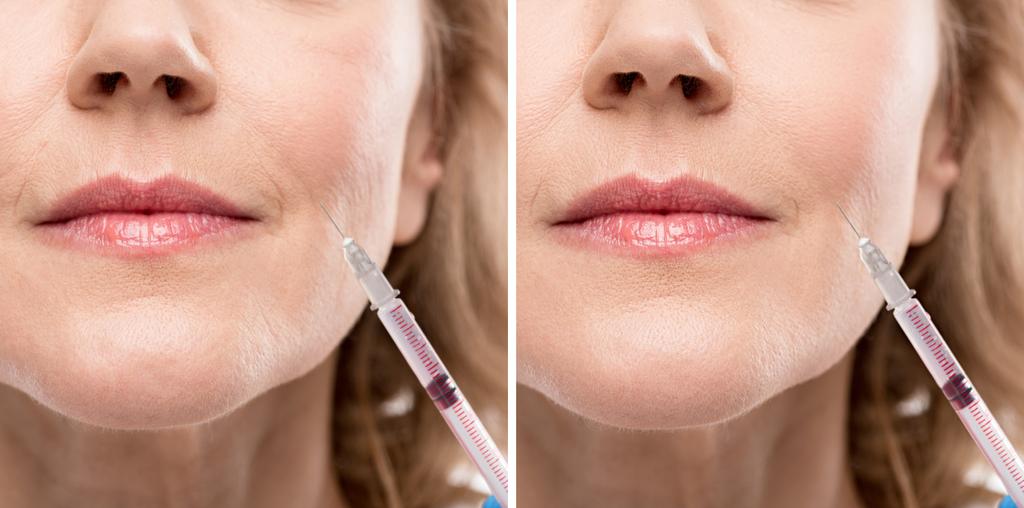 collage of middle aged woman receiving beauty injection before and after retouching - Photo, Image