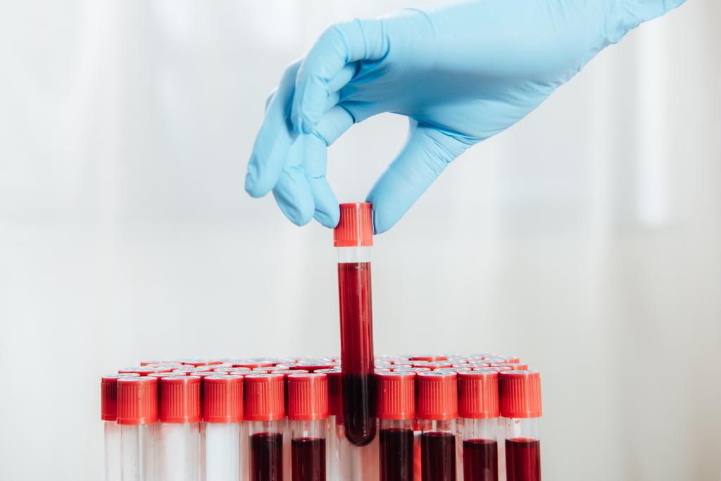 vista recortada del médico en guante de látex sosteniendo tubo de prueba con sangre
 - Foto, imagen