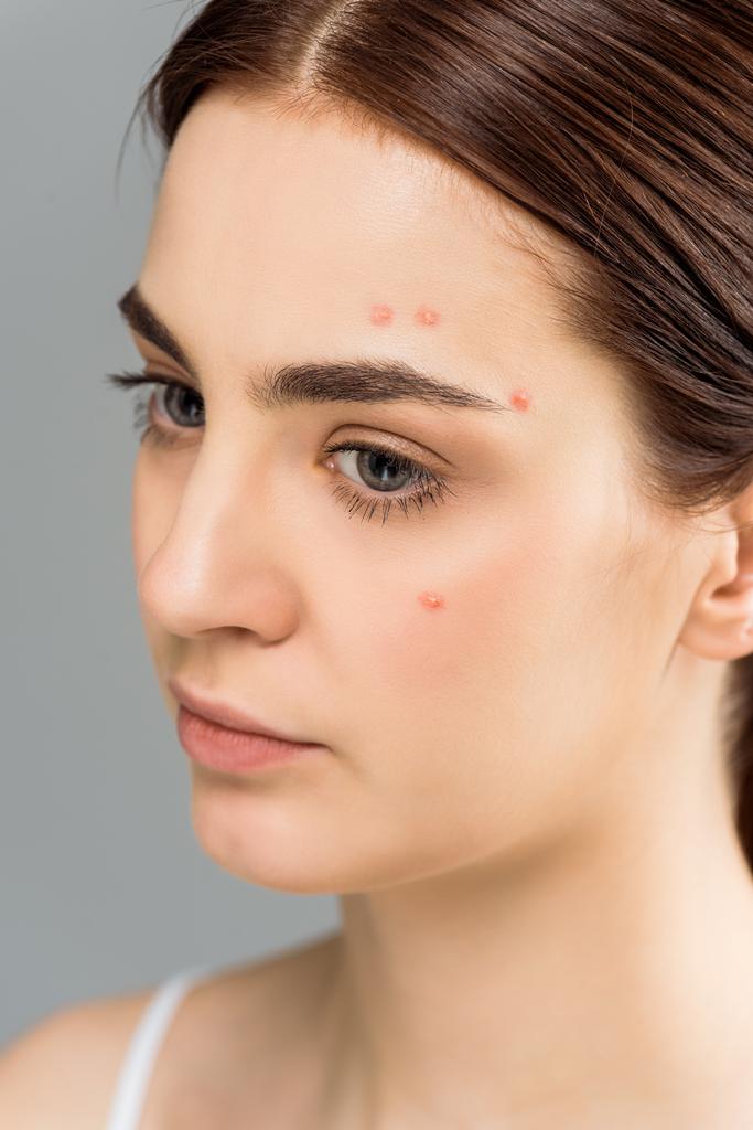 bouleversé jeune femme avec acné sur le visage isolé sur gris
  - Photo, image