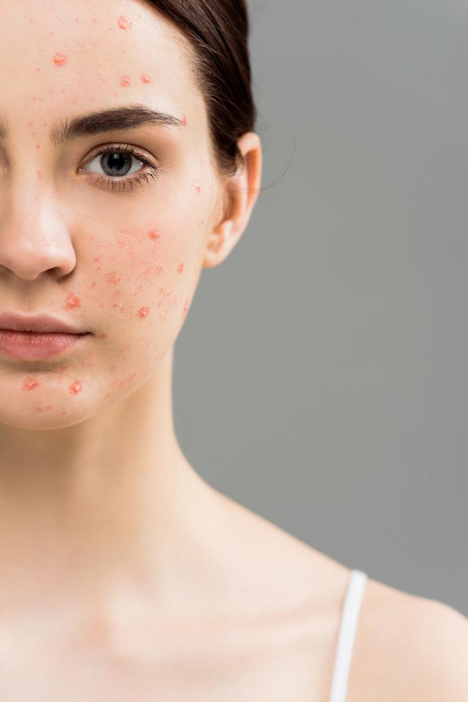 cropped view of young woman with acne looking at camera isolated on grey  - Photo, Image