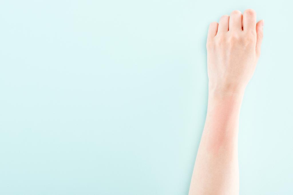 vista cortada da mão com reação alérgica isolada no azul
 - Foto, Imagem