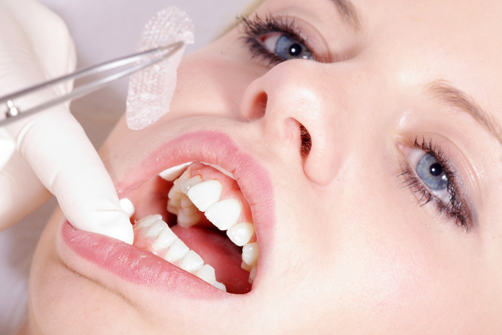 kosmetické zubní čištění - Fotografie, Obrázek