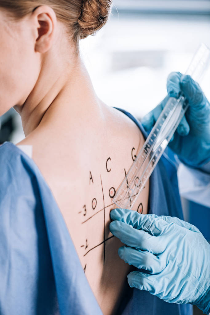 przycięty widok alergologa w rękawiczkach lateksowych trzymającego linijkę w pobliżu pacjenta z zaznaczonym grzbietem  - Zdjęcie, obraz