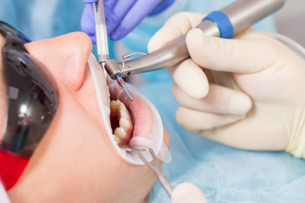 Пациенту мужского пола делают имплантацию в стоматологической клинике. Дантист держит дрель с имплантатом
. - Фото, изображение