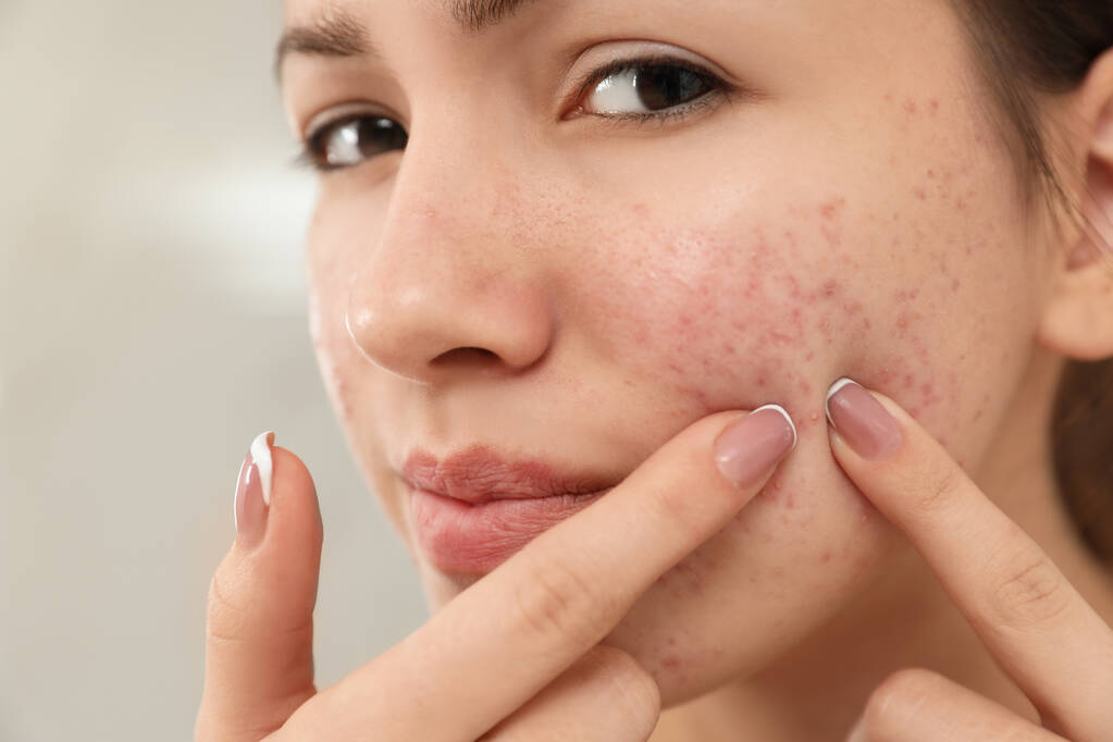 Menina adolescente com problema de acne espremendo espinha em seu rosto, closeu
 - Foto, Imagem