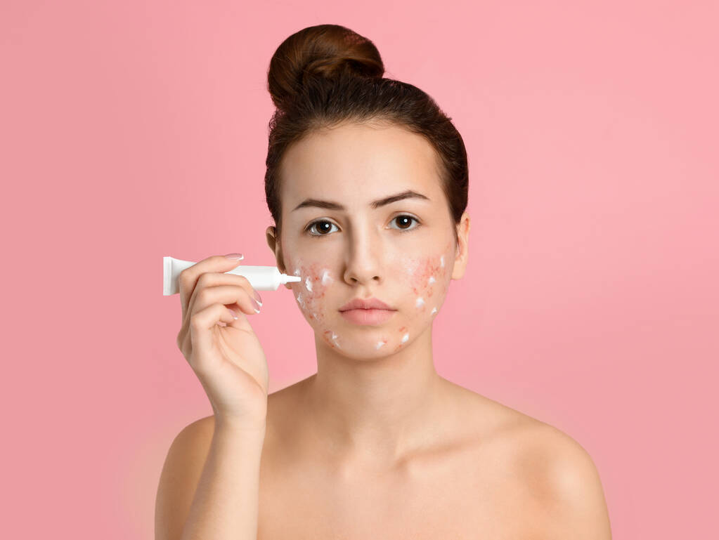 Adolescente chica con problemas de acné aplicación de crema en la luz rosa backgro
 - Foto, Imagen