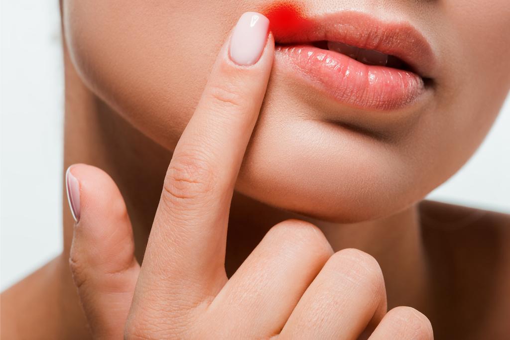 cropped view of woman pointing with finger at lips with herpes isolated on white  - Photo, Image