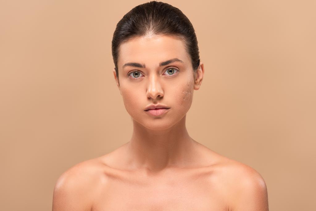 young naked woman with problem skin looking at camera isolated on beige  - Photo, Image