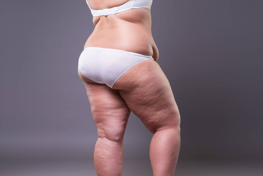 Mujer con sobrepeso, piernas gordas y nalgas, obesidad cuerpo femenino
 - Foto, Imagen