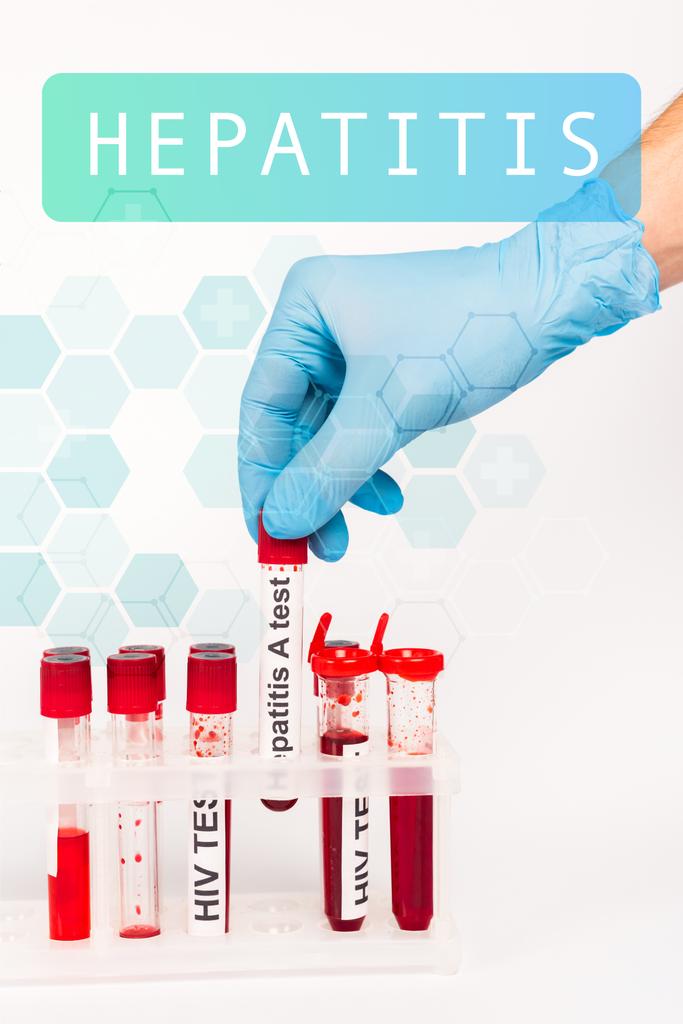 vista cortada do cientista em luva de látex azul exploração amostra com hepatite um teste perto de letras hepatite em branco
  - Foto, Imagem