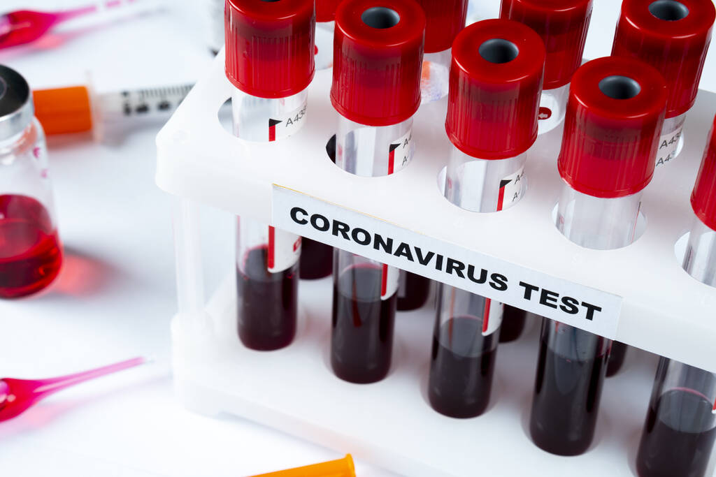 Coronavirus vérvizsgálat koncepció. Vérmintát analizálok a kémcsőben a koronavírus teszthez. Tesztcső vérrel a 2019-es ncov elemzéshez. A koronavírus vérvizsgálati koncepciója. - Fotó, kép
