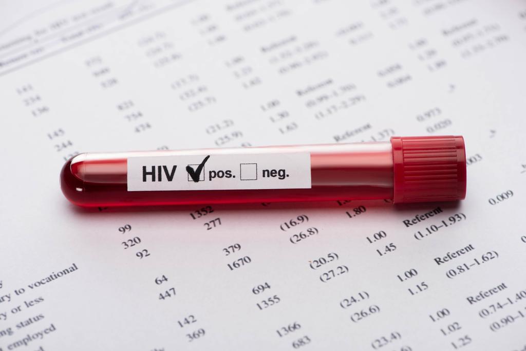陽性HIV血液サンプル検査結果フォーム - 写真・画像