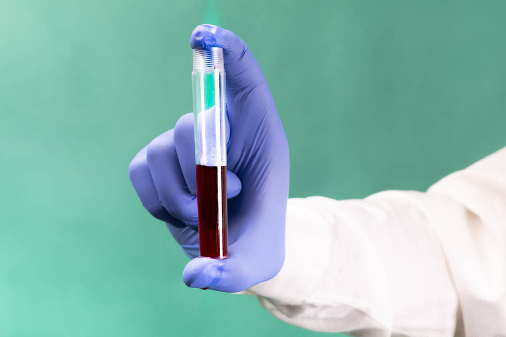 A hand in medical glove, holding a test tube with blood sample, on a green background, close-up. Periodic blood test. Coronavirus test. A corona pandemic. - Photo, Image