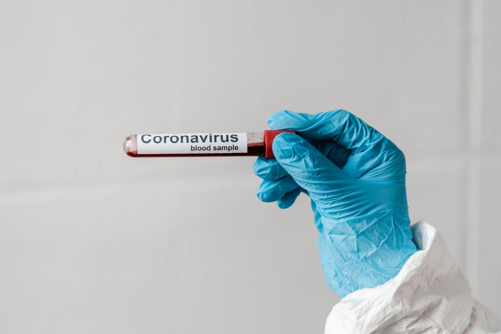 vista recortada de la persona en guante de látex que sostiene la muestra de sangre del coronavirus
 - Foto, Imagen