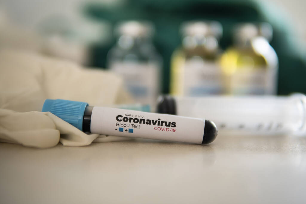 Yeni Corona virüsü enfeksiyonu (yeni Corona virüsü hastalığı 2019) teşhisi için pozitif COVID-19 testi ve laboratuvar örneği. Bulaşıcı salgın konsepti - Fotoğraf, Görsel