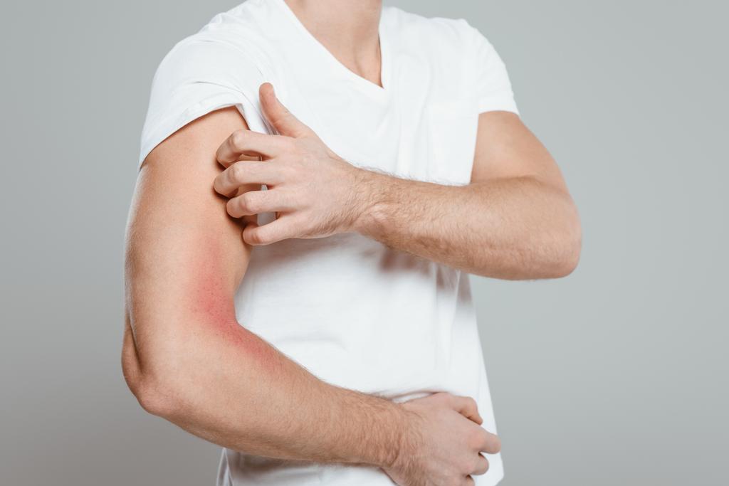 Dílčí pohled na člověka škrábání rukou s alergií izolované na šedé - Fotografie, Obrázek