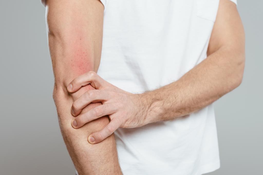 Vágott kilátás az ember megható kéz allergia elszigetelt szürke - Fotó, kép