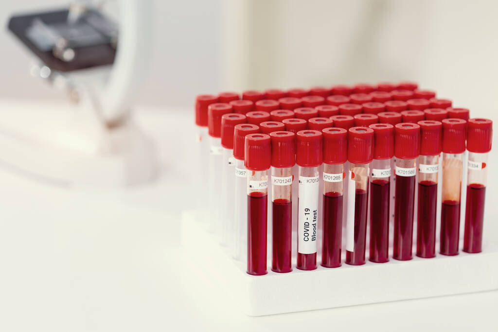 Covid-19 infizierte Blutprobe in Röhre und Mikroskop auf dem Tisch im Forschungslabor - Foto, Bild
