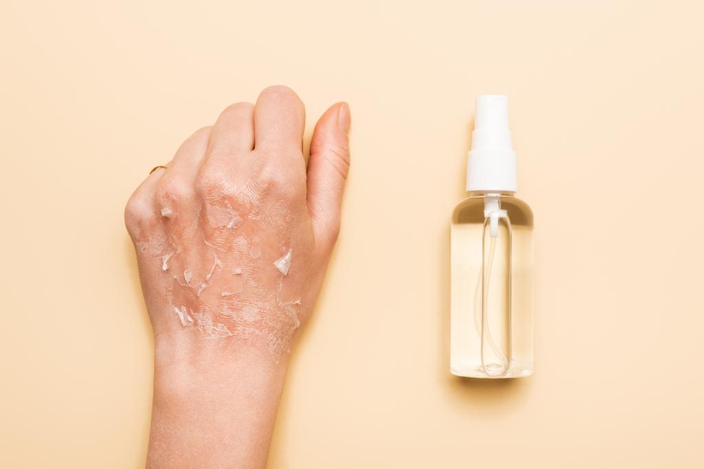 bijgesneden weergave van vrouwelijke hand met gedehydrateerde, geexfolieerde huid in de buurt van ontsmettingsmiddel op beige - Foto, afbeelding