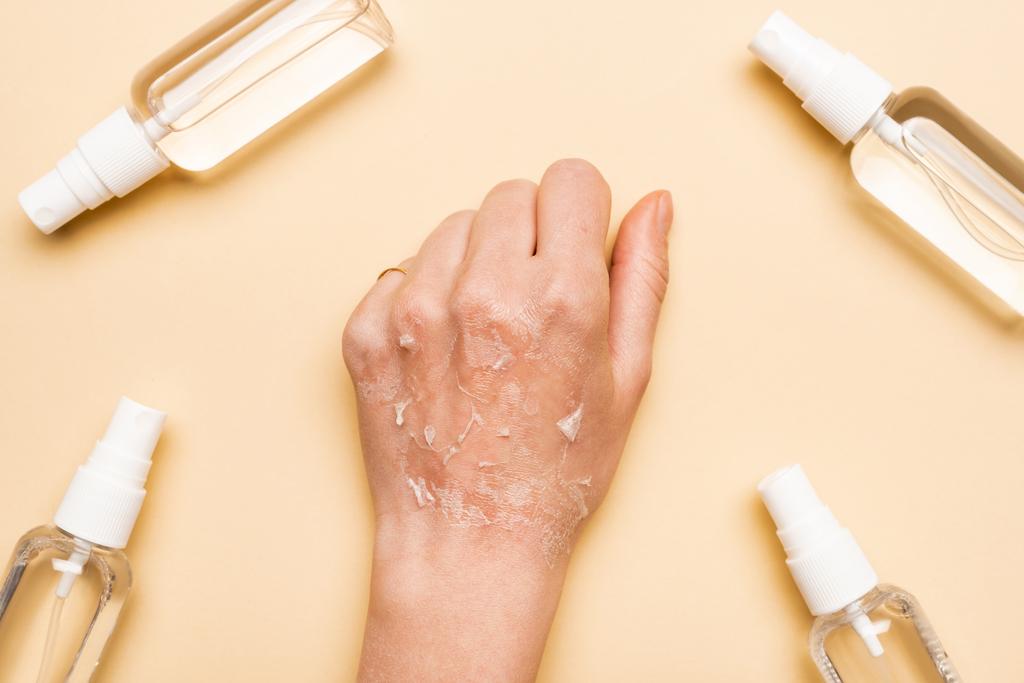 rajattu näkymä naisen käsi kuiva, hilseilevä iho lähellä spray pullot antiseptinen beige - Valokuva, kuva
