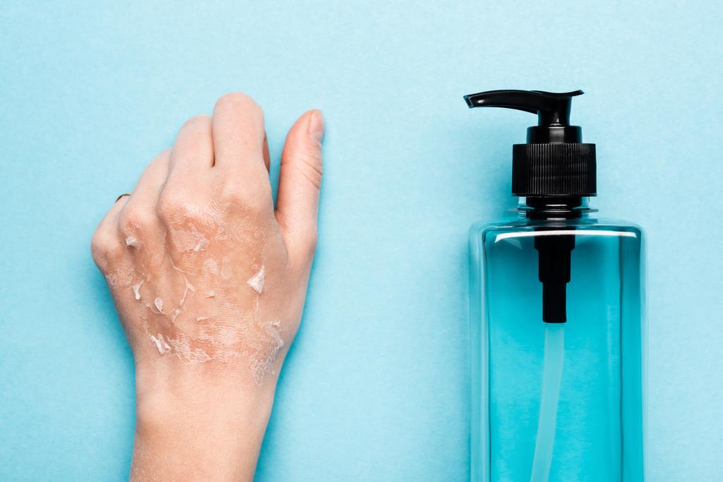 vue partielle de la main féminine avec peau exfoliée et sèche près d'un désinfectant sur fond bleu - Photo, image