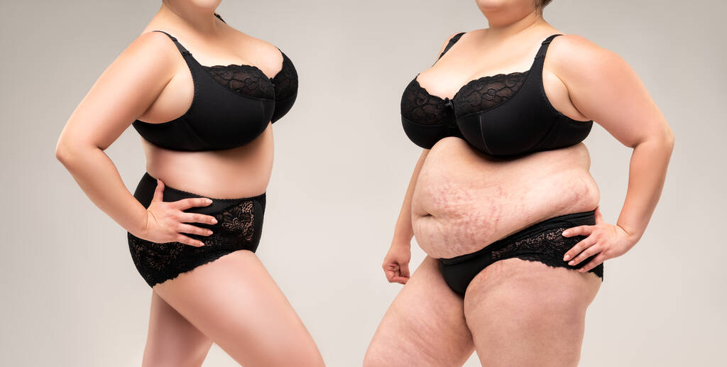 Σώμα της γυναίκας πριν και μετά την απώλεια βάρους σε γκρι φόντο, πλαστική χειρουργική έννοια - Φωτογραφία, εικόνα