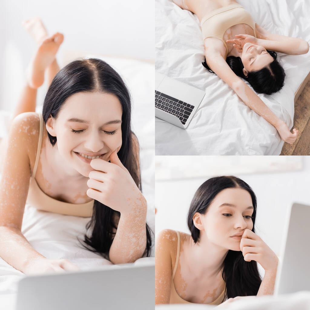 kolaż brunetka kobieta z bielactwo leżące na łóżku i za pomocą laptopa - Zdjęcie, obraz