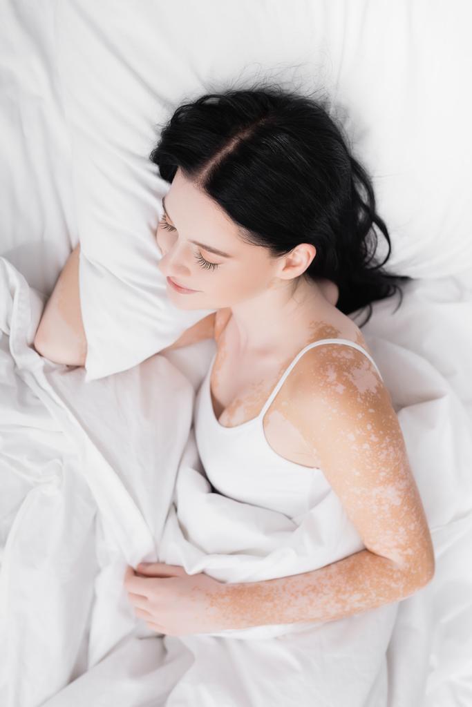 vista superior de la joven morena con vitiligo durmiendo en la cama - Foto, imagen