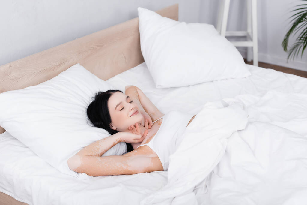 faule junge Frau mit Vitiligo auf dem Bett liegend und streckend - Foto, Bild