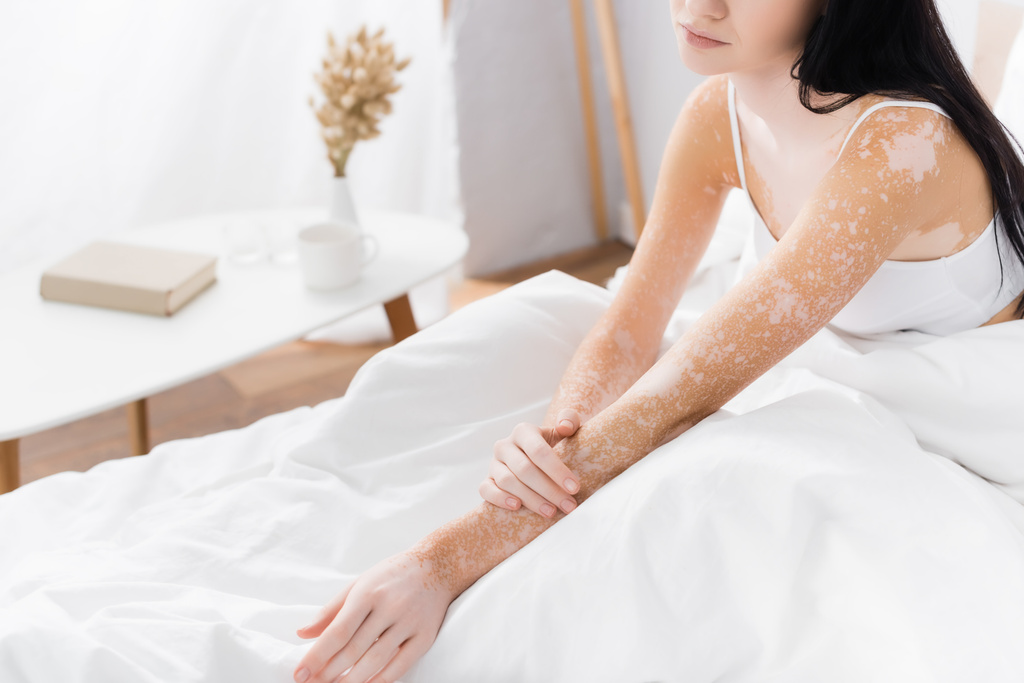 vista parcial de mujer joven con vitiligo en el dormitorio  - Foto, Imagen
